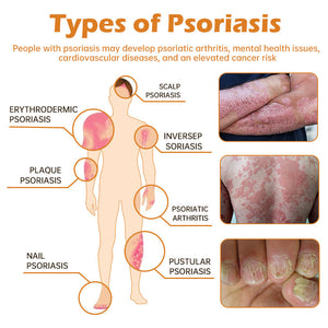 Novozelandska krema za zdravljenje psoriaze s čebeljim strupom (primerna za vse kožne bolezni)