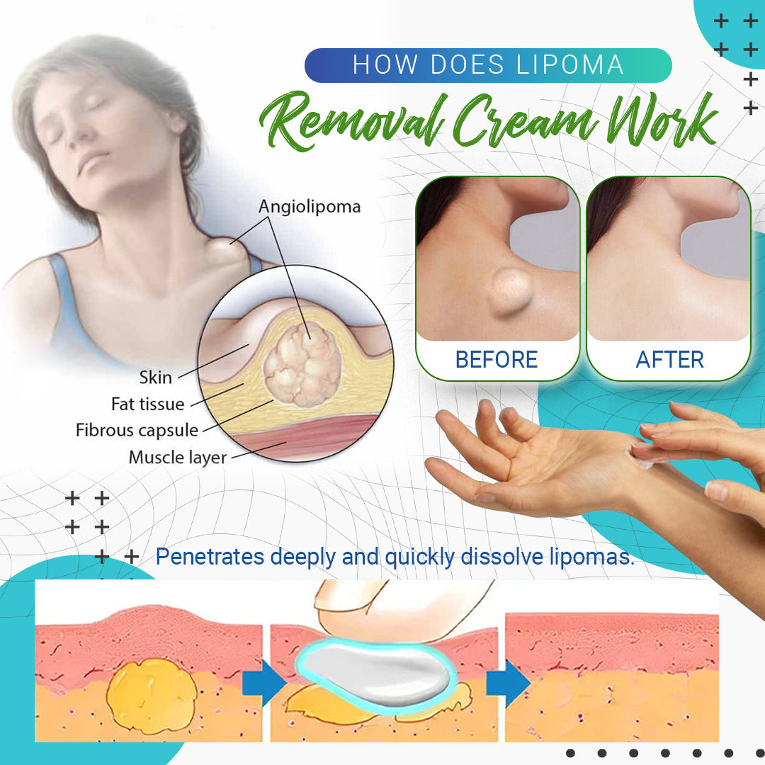 Krema za odstranjevanje lipoma Lump Free™