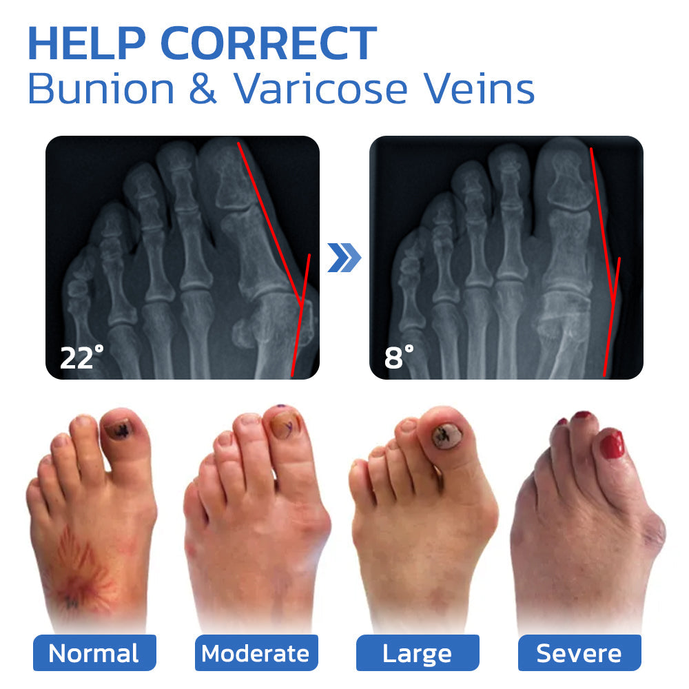 Medicinske nogavice GFOUK AntiBunion in VeinHeal